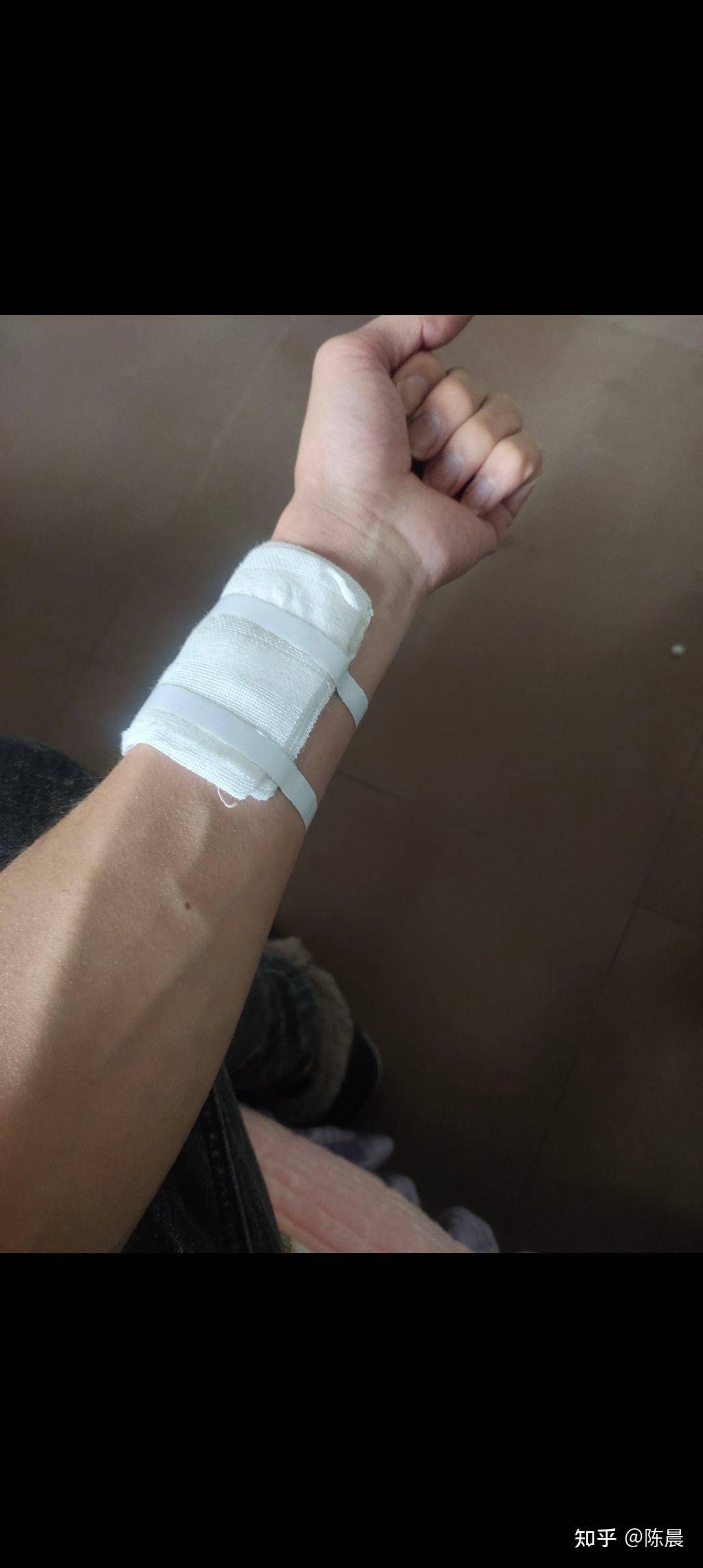 肾衰竭都有什么症状？  第4张