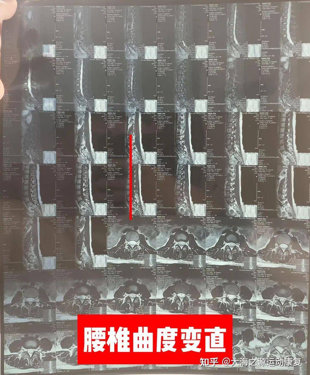 有没有腰肌劳损的哥哥姐姐们可以分享一下怎么缓解疼痛吗？  第2张