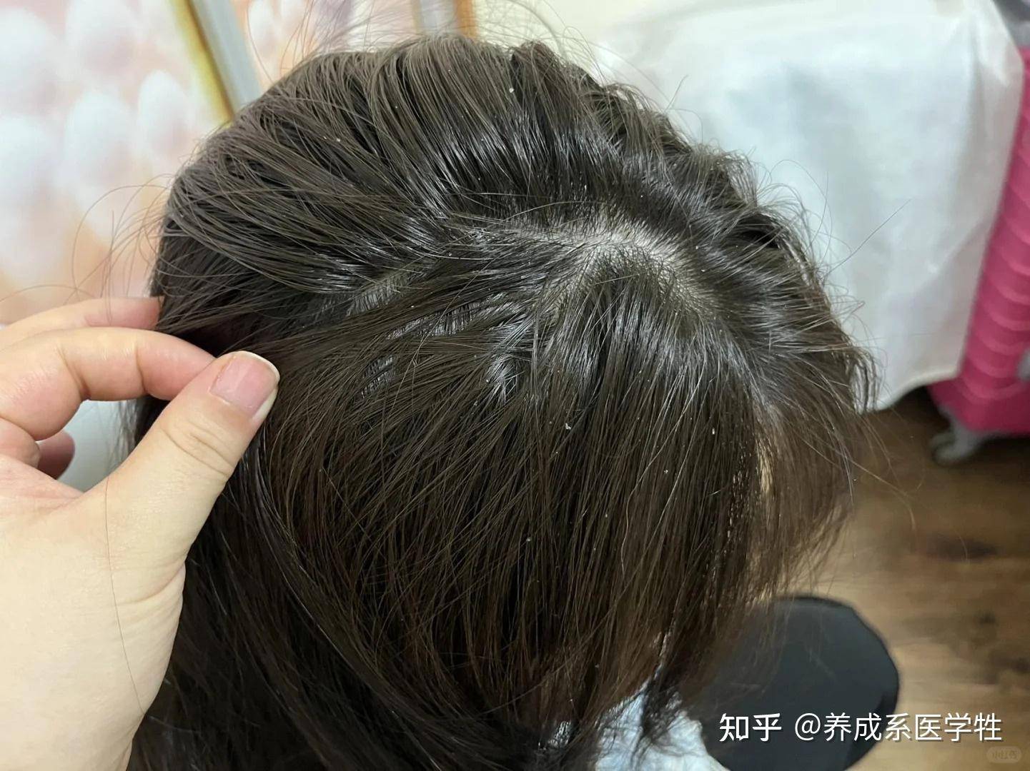 从专业角度来看，二硫化硒是不是比洗发水更适合去屑？  第5张