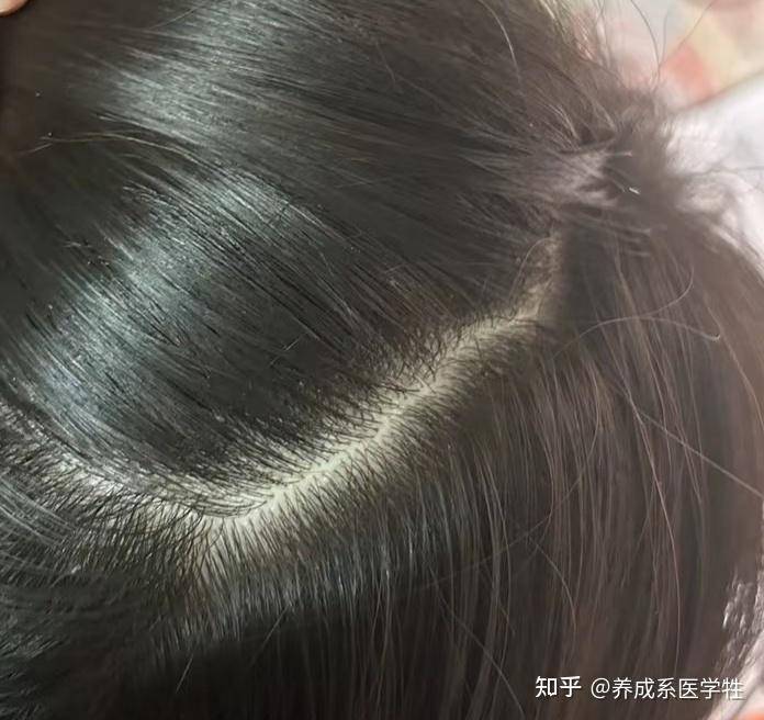 从专业角度来看，二硫化硒是不是比洗发水更适合去屑？  第6张