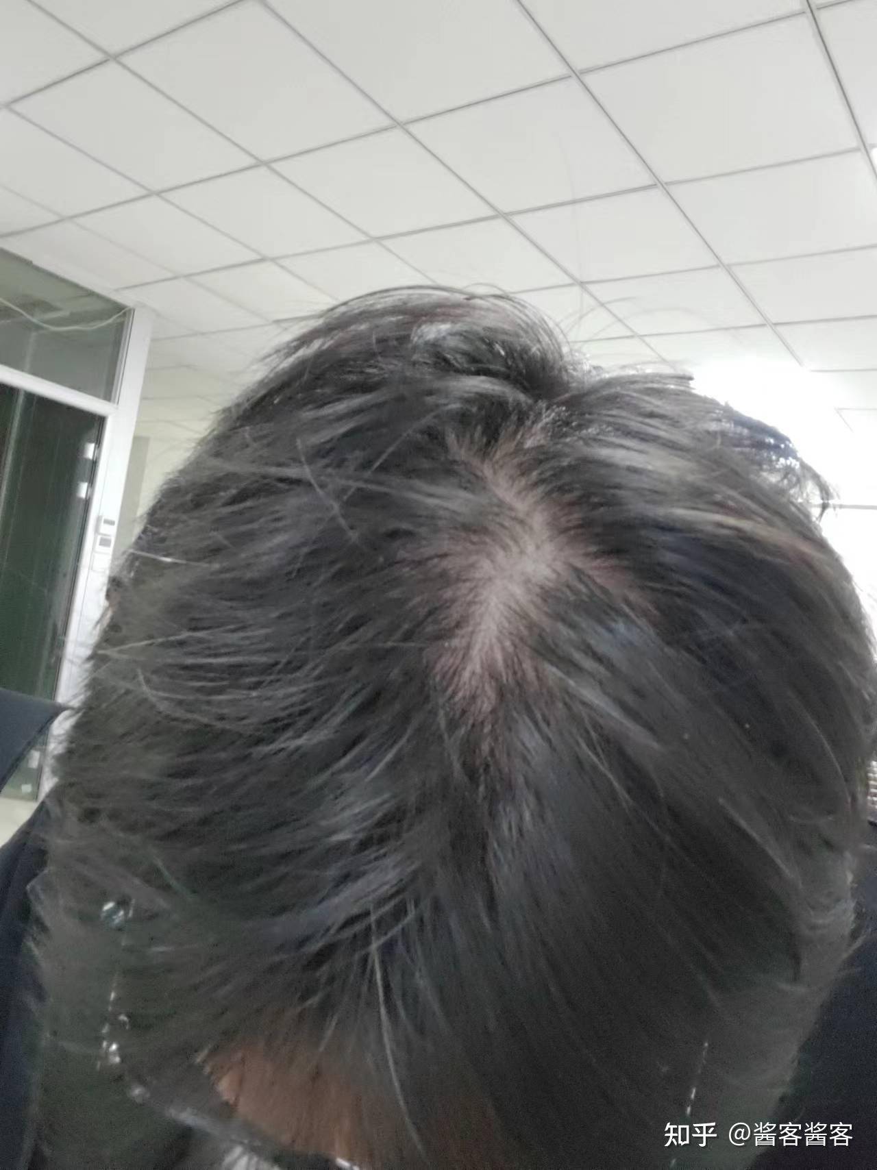 米诺地尔到底有没有用？  第2张