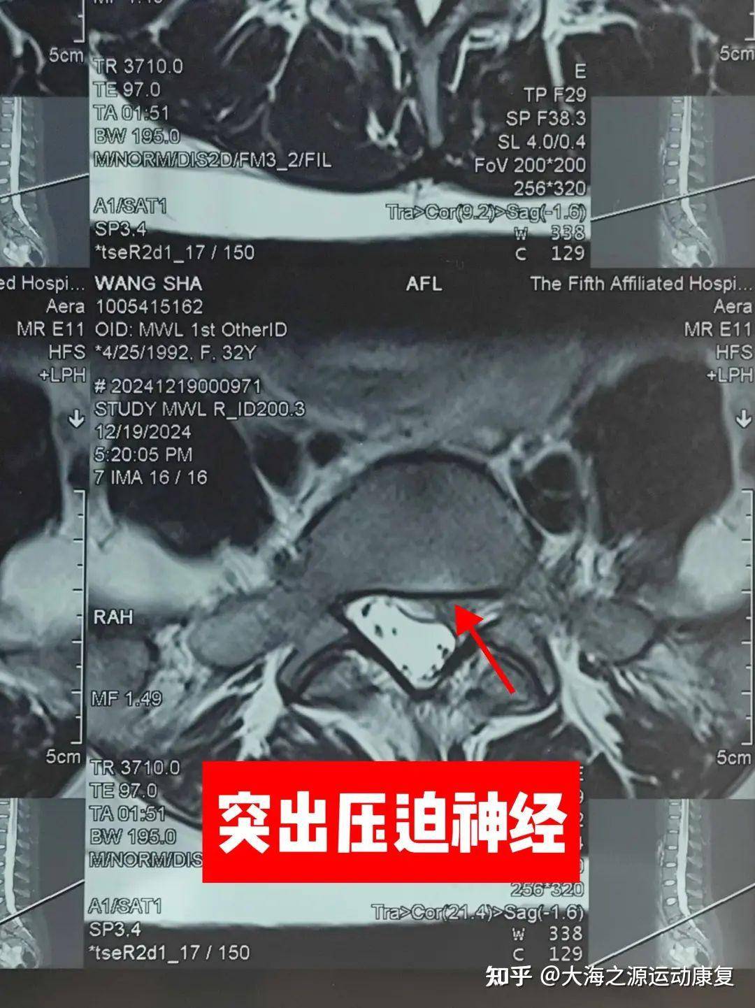 有没有腰肌劳损的哥哥姐姐们可以分享一下怎么缓解疼痛吗？  第1张