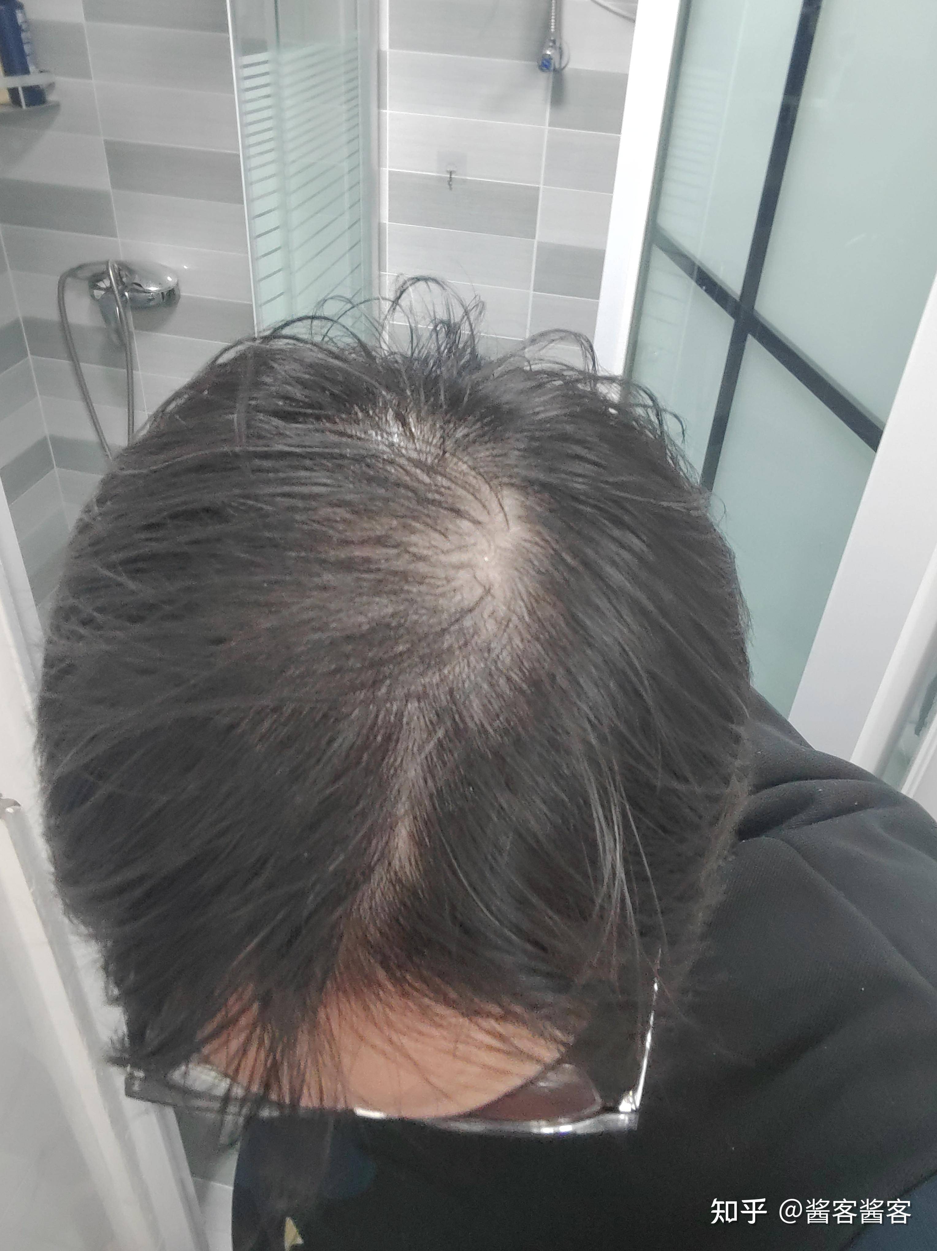 米诺地尔到底有没有用？  第1张