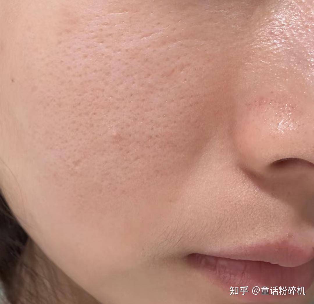 脸部皮肤毛孔粗大如何改善？  第5张