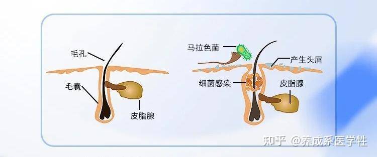 从专业角度来看，二硫化硒是不是比洗发水更适合去屑？  第3张