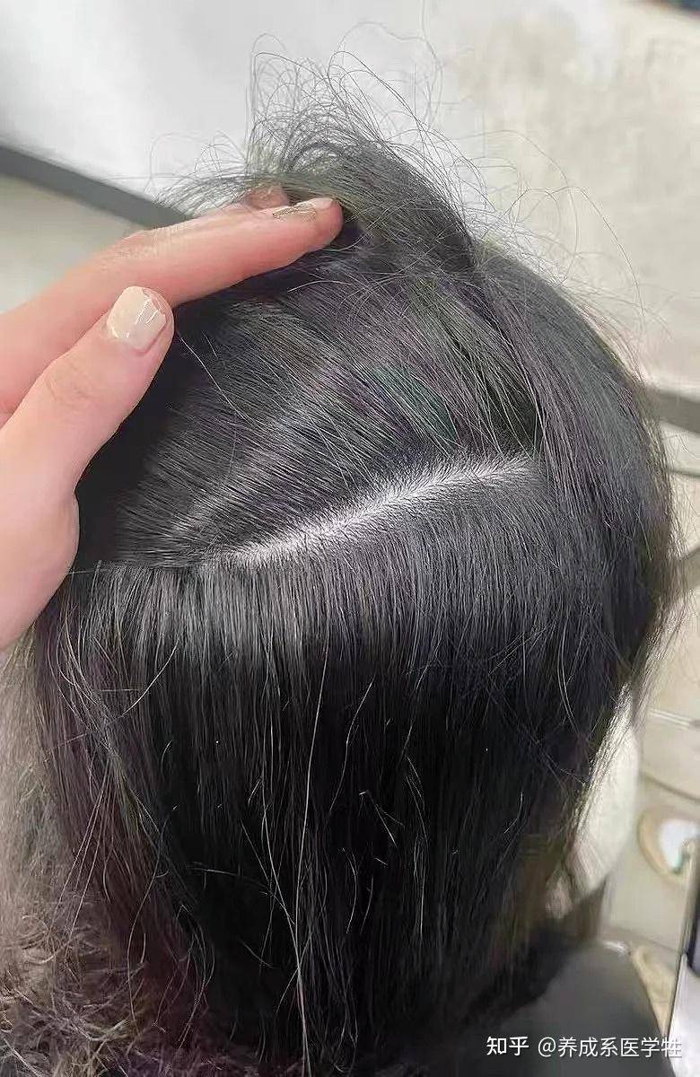 从专业角度来看，二硫化硒是不是比洗发水更适合去屑？  第7张